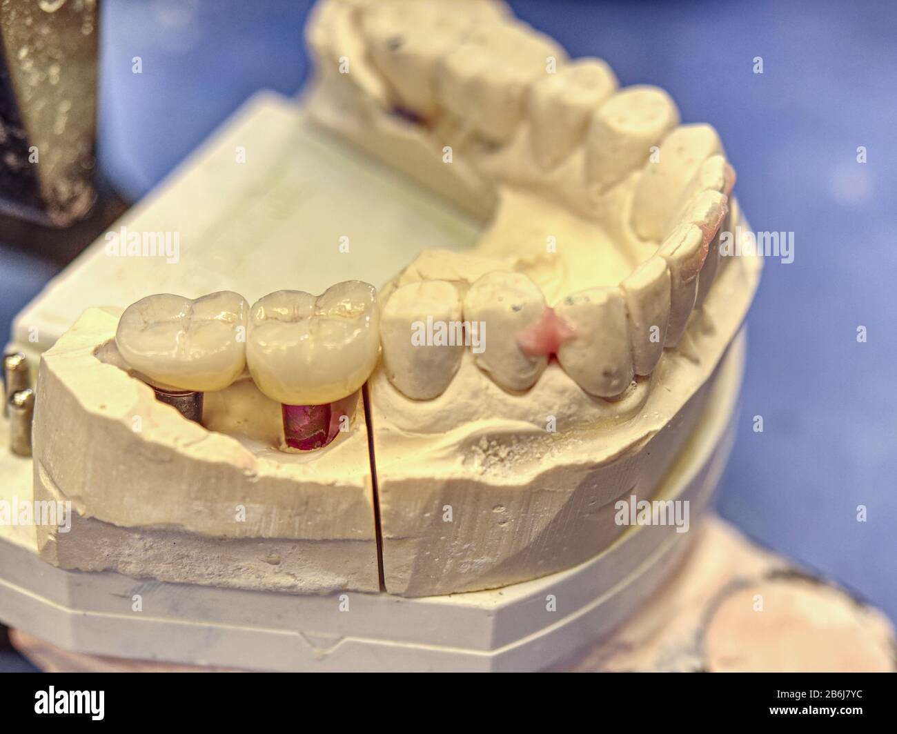 Plaster Cast of jaws. Dental casting gypsum model human Jaws in