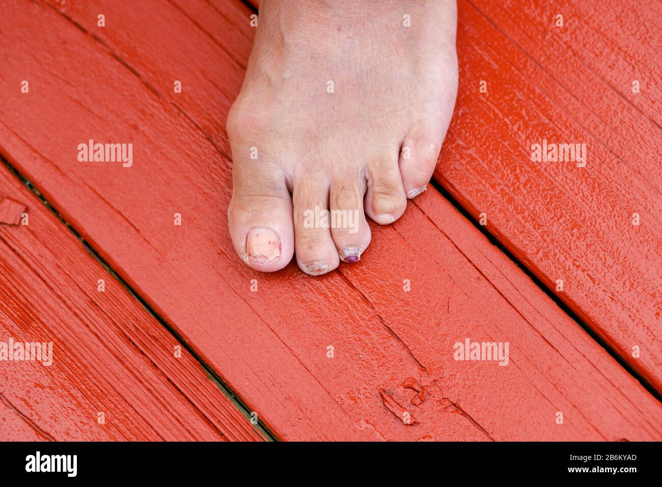 Toe nail damage hi-res stock photography and images - Alamy