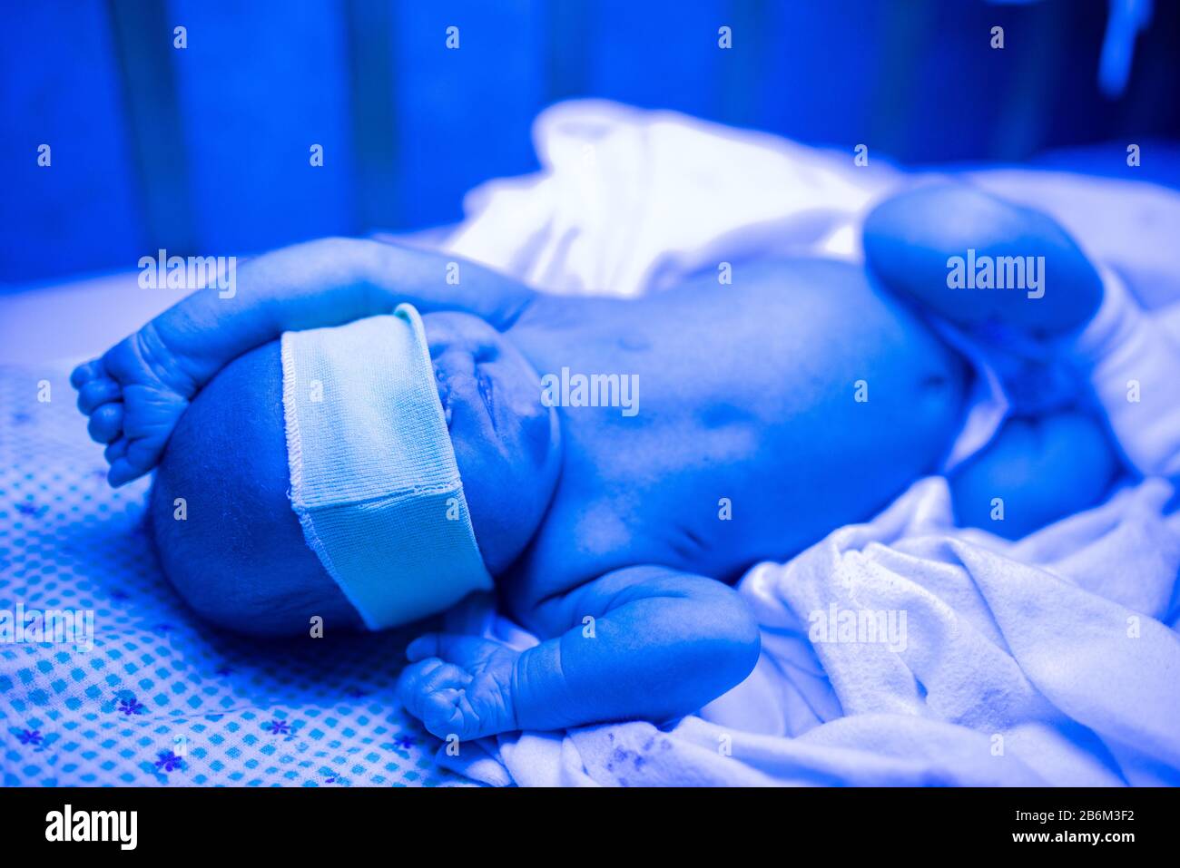 Newborn having a treatment for jaundice under ultraviolet light, Baby has high level of