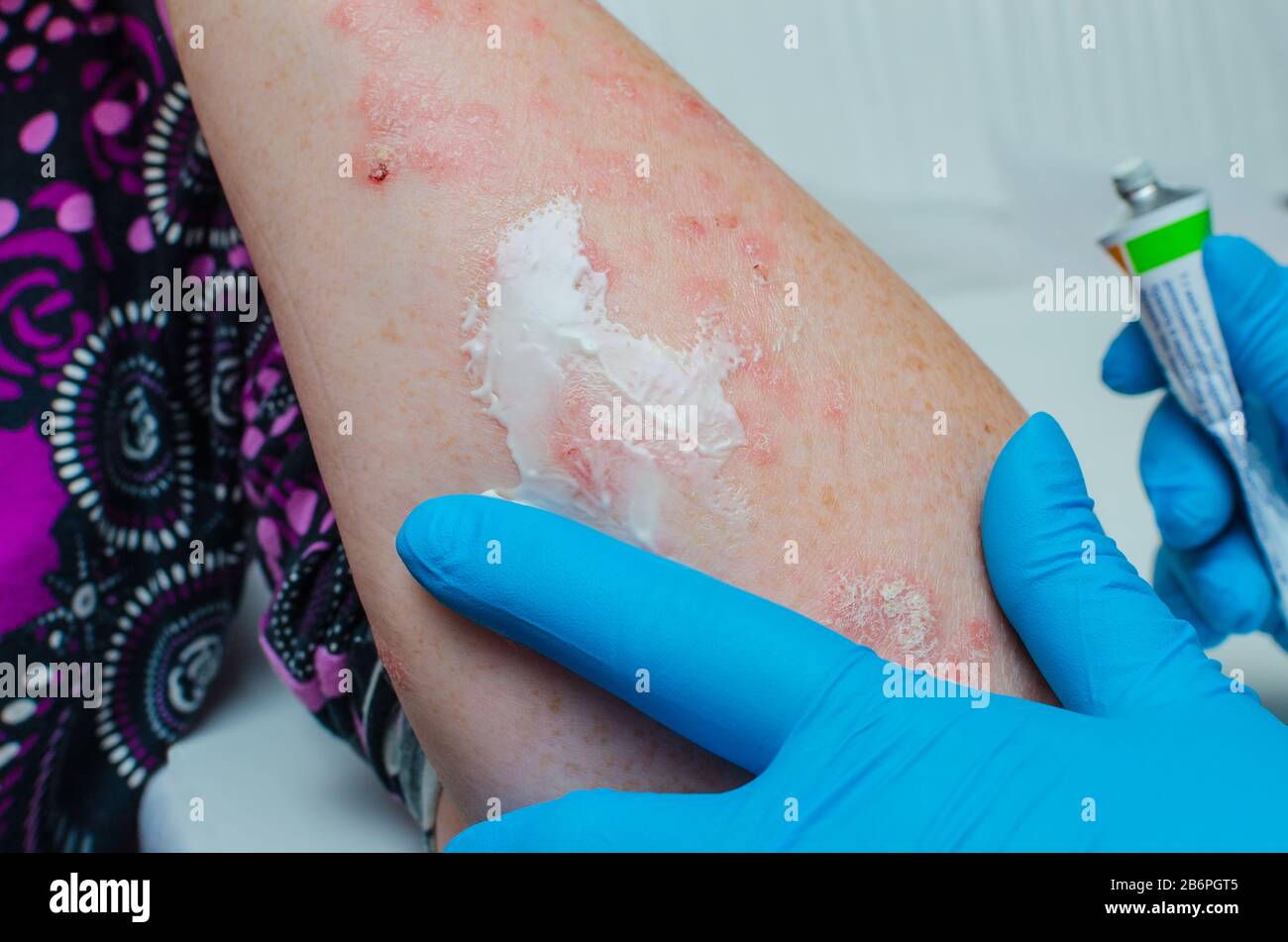 A dermatologist in gloves applies a therapeutic ointment to the