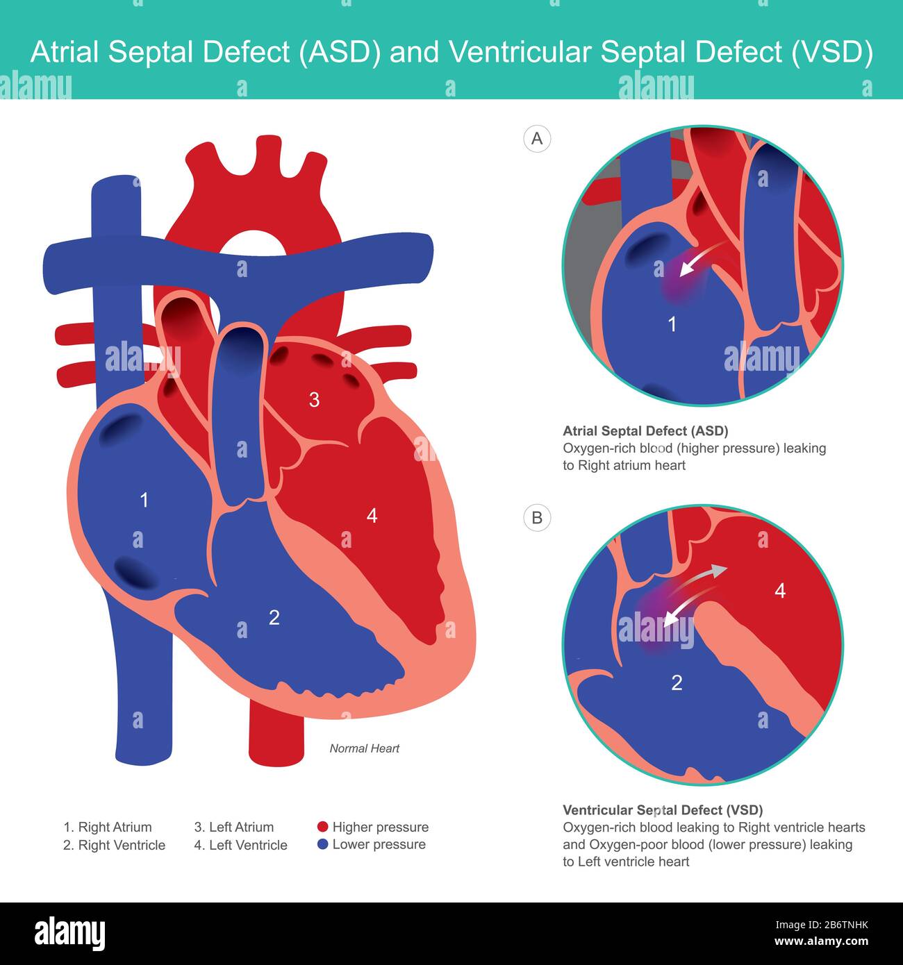 Atrial Septal Defect (ASD) and Ventricular Septal Defect (VSD). Abnormal of the heart atrial and heart ventricle from baby birth. Stock Vector