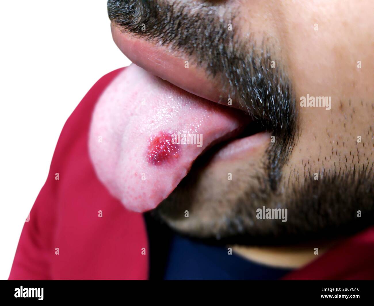 A closeup of a diseased tongue in which a red spot glosses. Burning and discomfort of the tongue Stock Photo