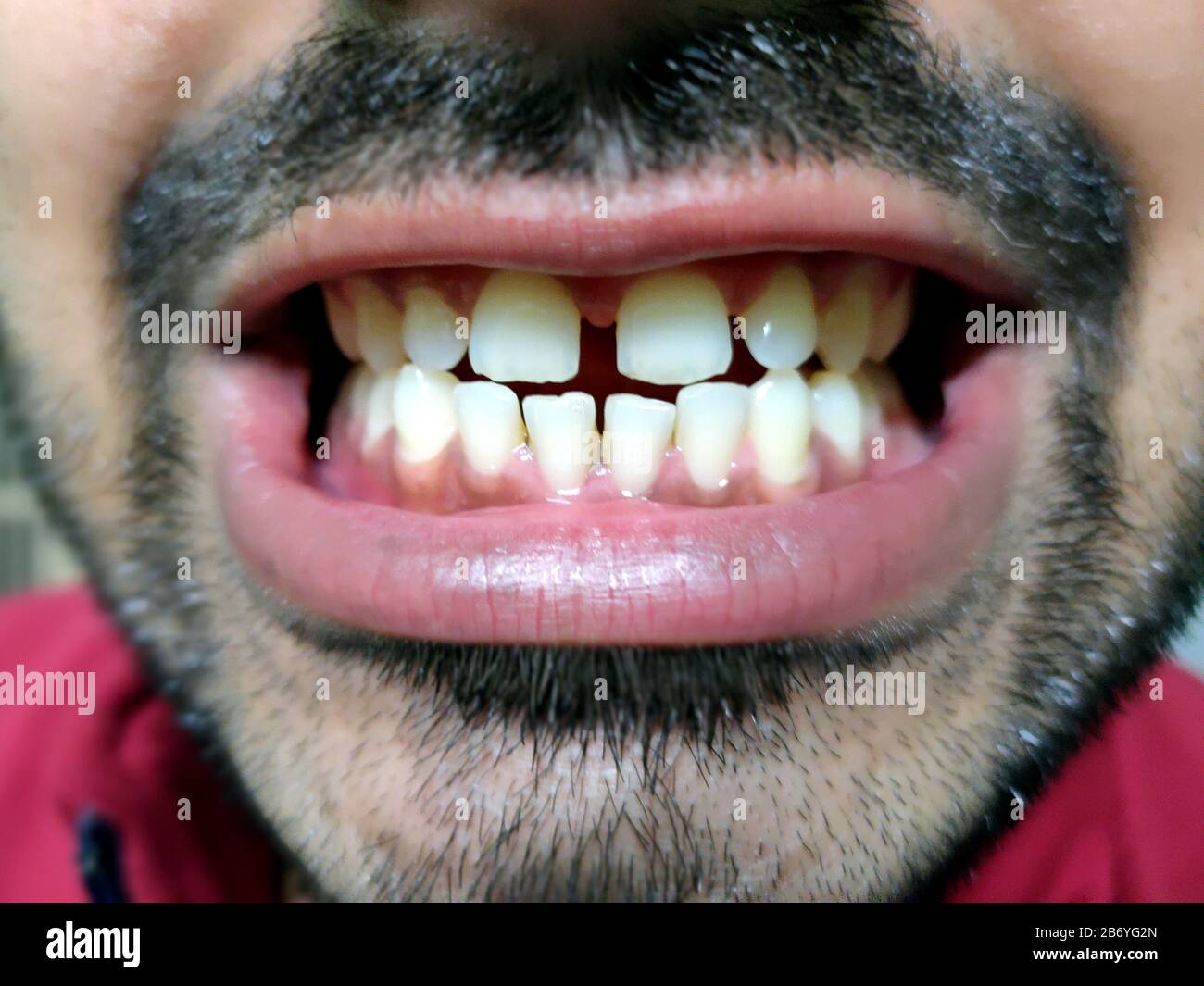 Gap teeth hi-res stock photography and images - Alamy