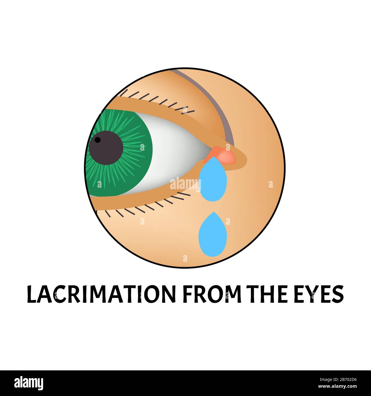 Lacrimation from the eyes. Symptom of conjunctivitis, allergies