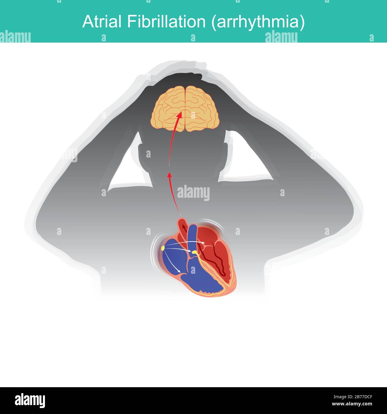 Atrial Fibrillation. Patients condition in which the electrical signals in heart malfunctioning or causing a short circuit in heart rhythm. Stock Vector
