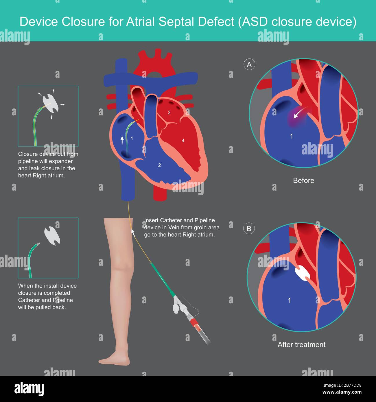 Devices Closure for Atrial Septal Defect. Explain treatment The Atrial Septal Defect (ASD) abnormality by use medical Devices Closure wall heart in Ri Stock Vector