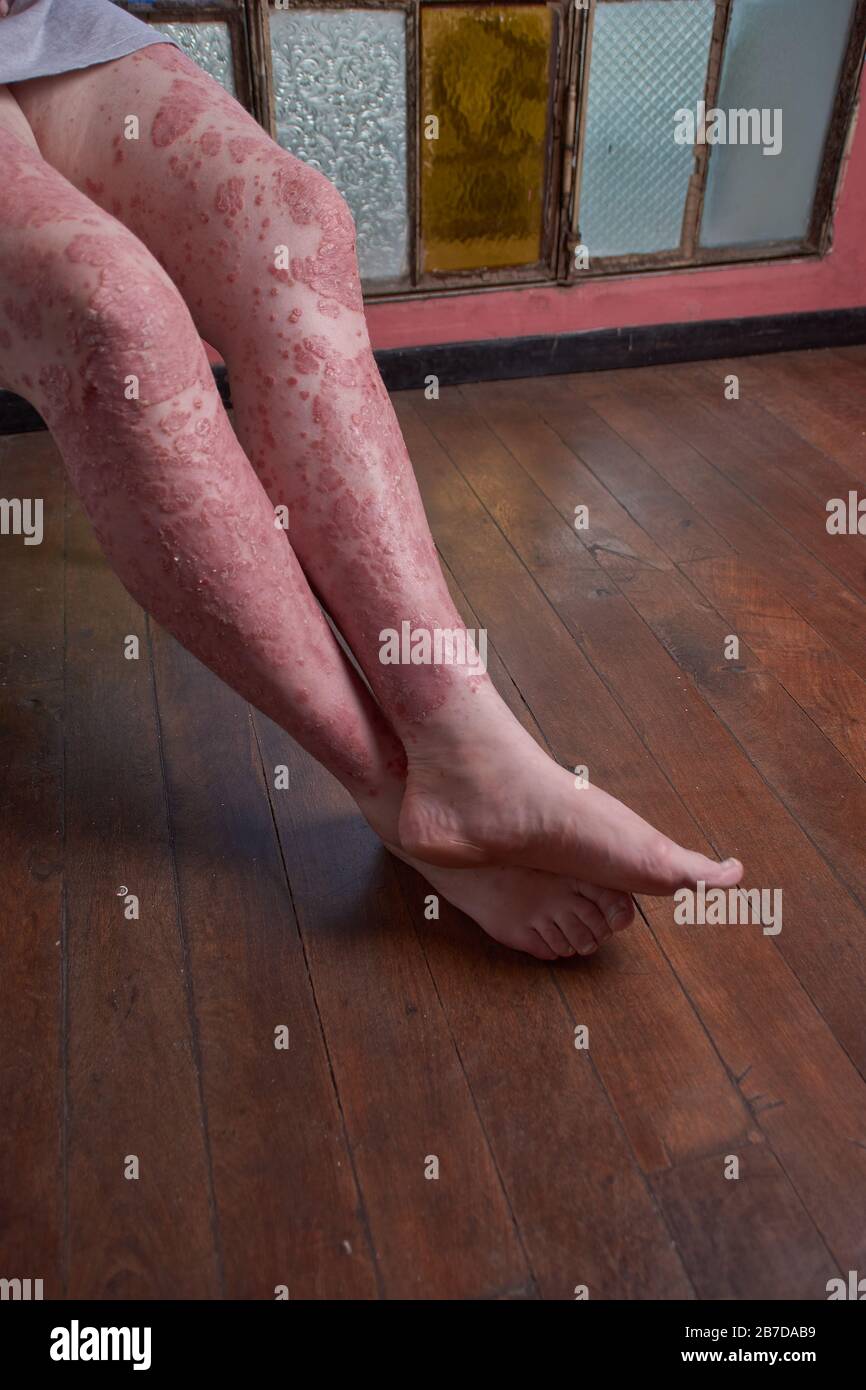 View of leg and feet of woman with Psoriasis Stock Photo