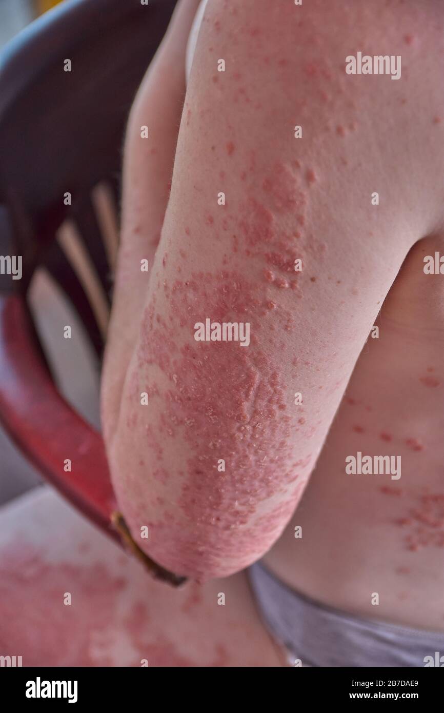 Psoriasis foot hi-res stock photography and images - Alamy