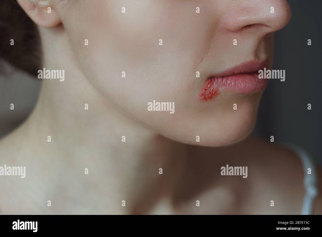 Cold Sore Stock Photos & Cold Sore Stock Images Alamy