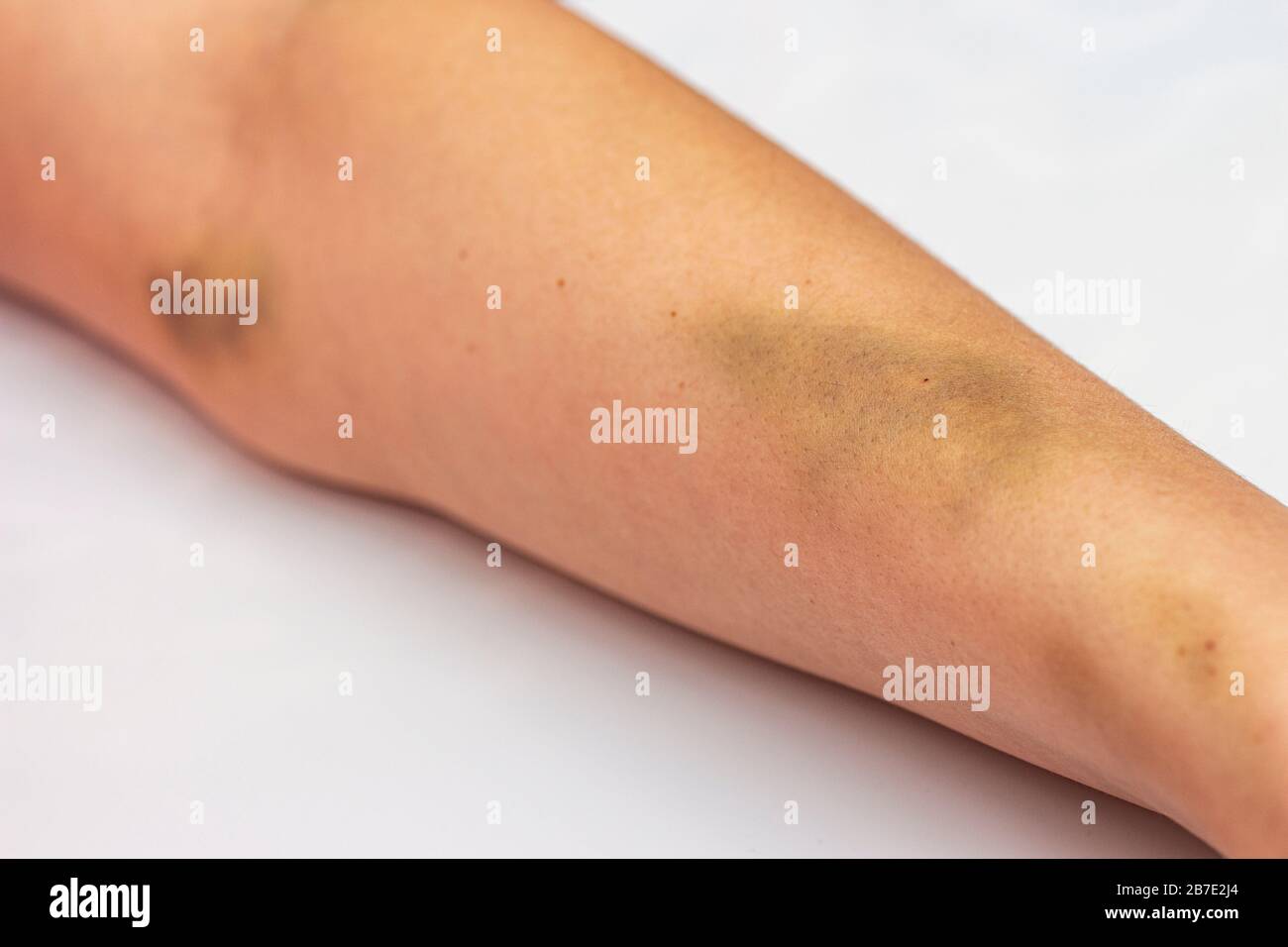 Hematoma arm hires stock photography and images Alamy