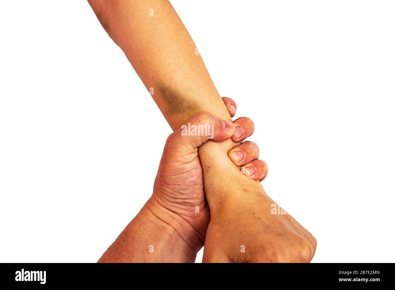 The man brutally grabbed the girl's hand and bruises appeared. Stock Photo