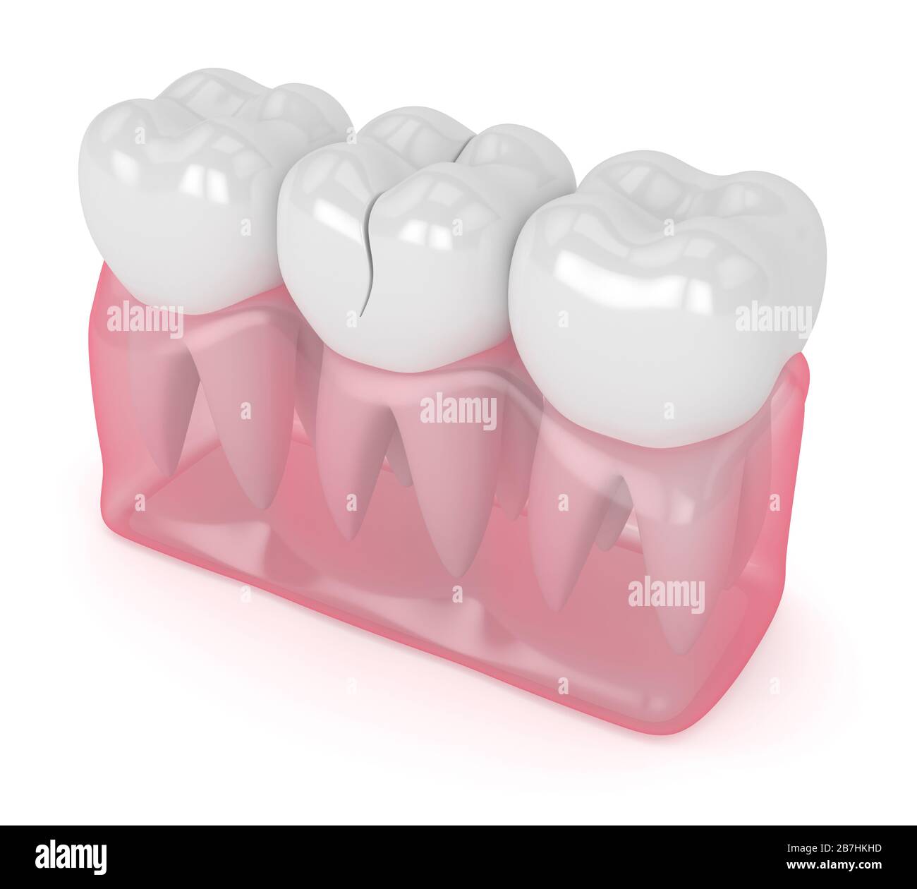 3d render of jaw with treatable cracked tooth over white background. Different types of broken teeth concept. Stock Photo