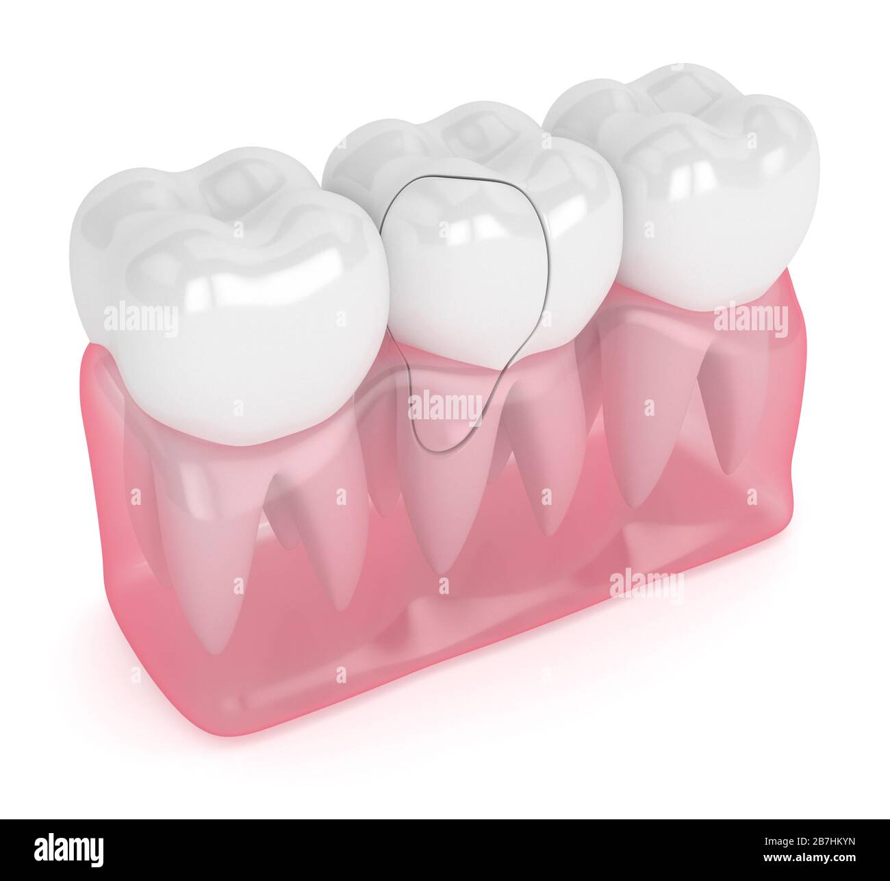 3d render of jaw with treatable cracked tooth over white background