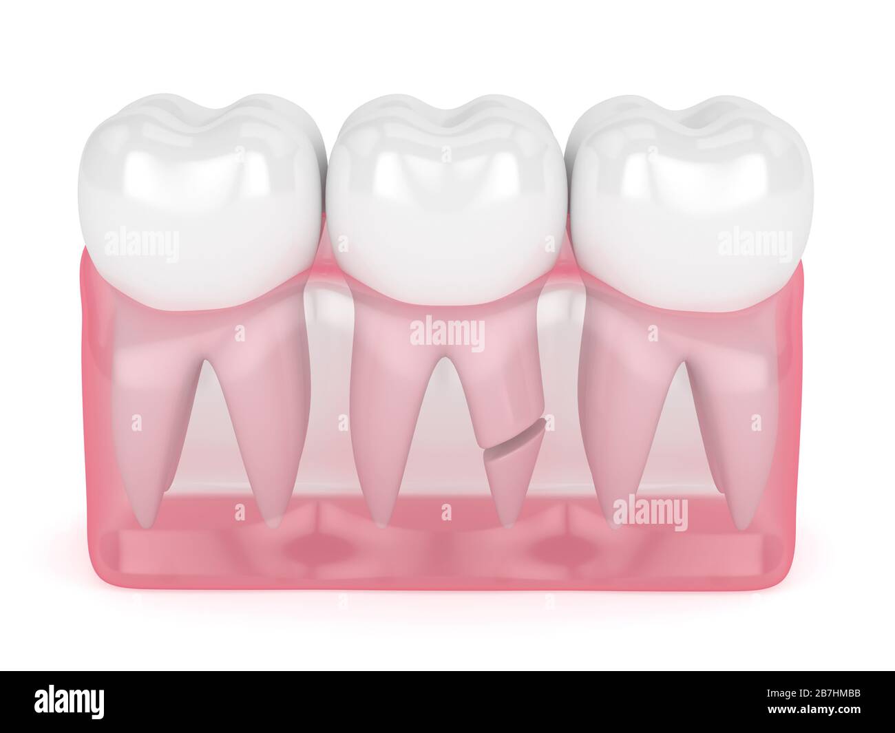 3d render of translucent gums with cracked tooth root over white background. Different types of broken teeth concept. Stock Photo
