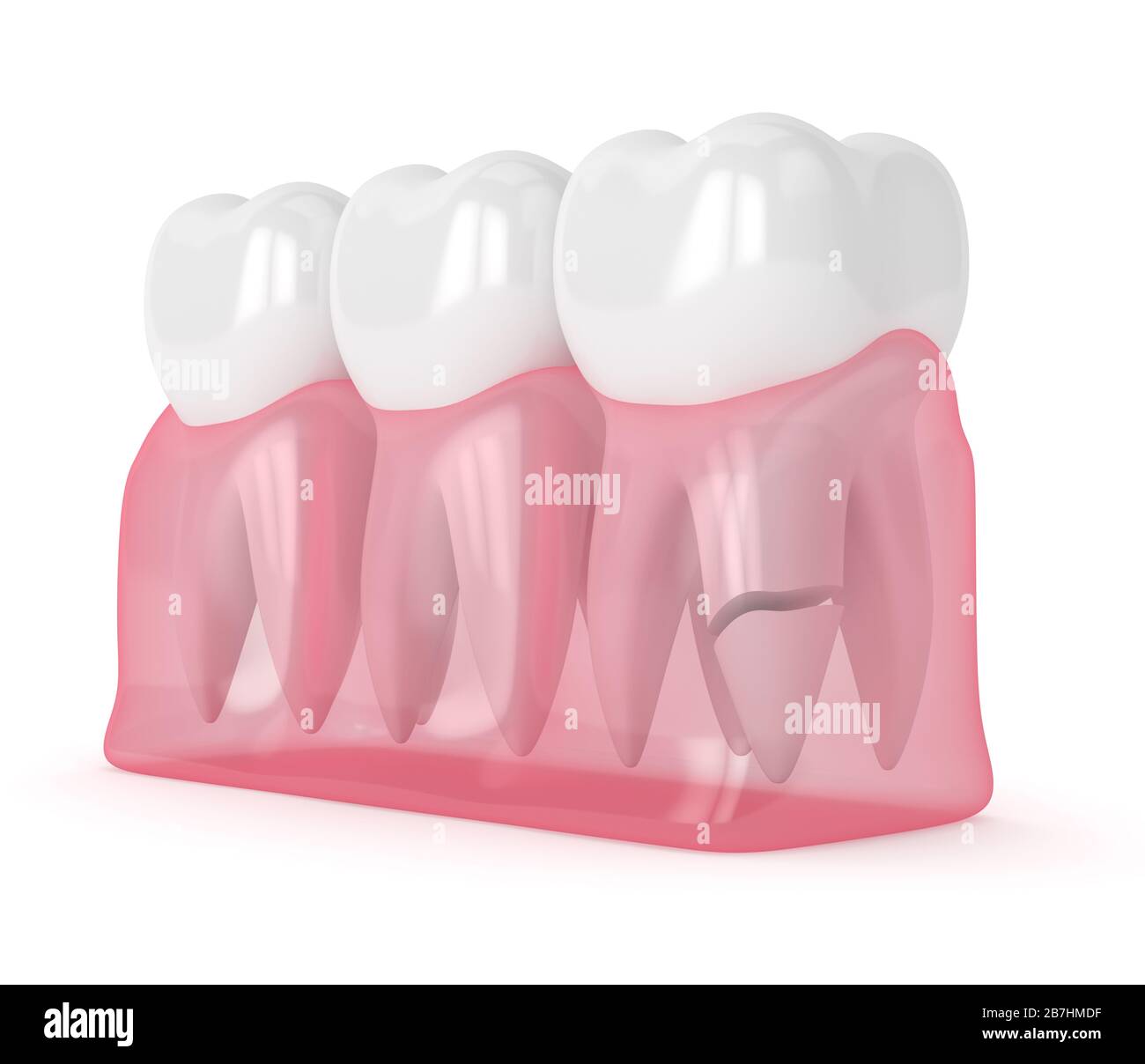 3d render of gums with cracked tooth root over white background. Different types of broken teeth concept. Stock Photo
