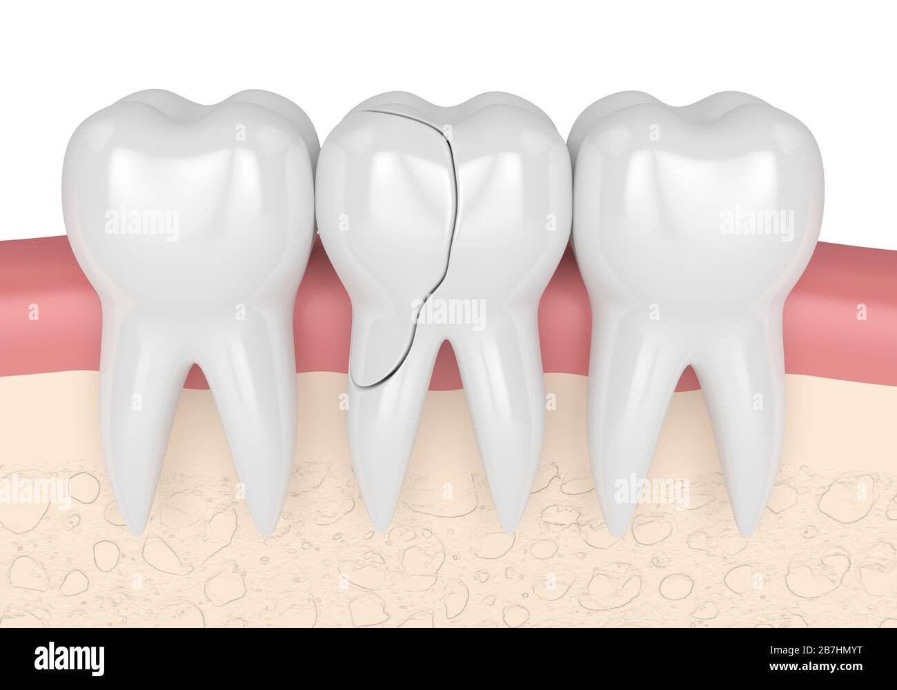 3d render of gums with treatable cracked tooth over white background
