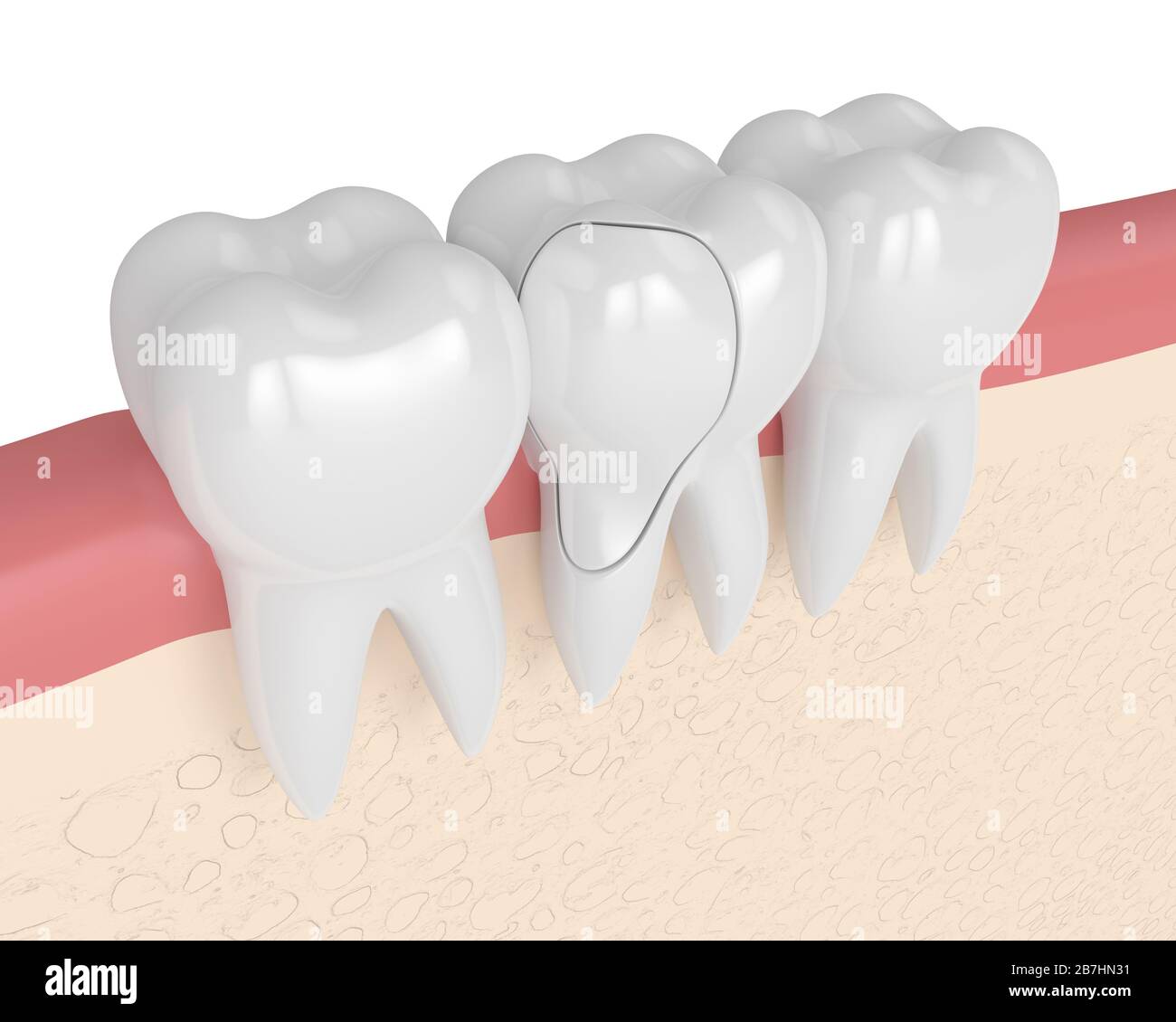 3d render of gums with treatable cracked tooth over white background