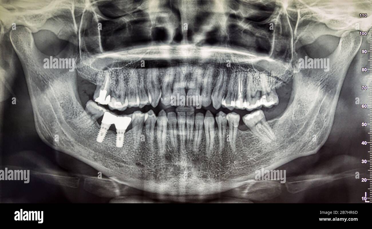 Dental xray of an adult patient, modern digital radiology for