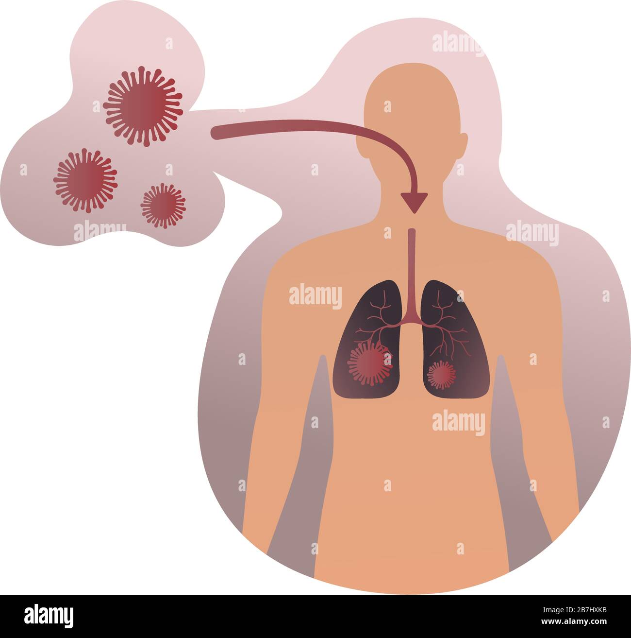 Infectious disease. Medical Infographic set with icons and other elements. 2019-nCoV corona virus concept with virus enters the lungs human on white Stock Vector