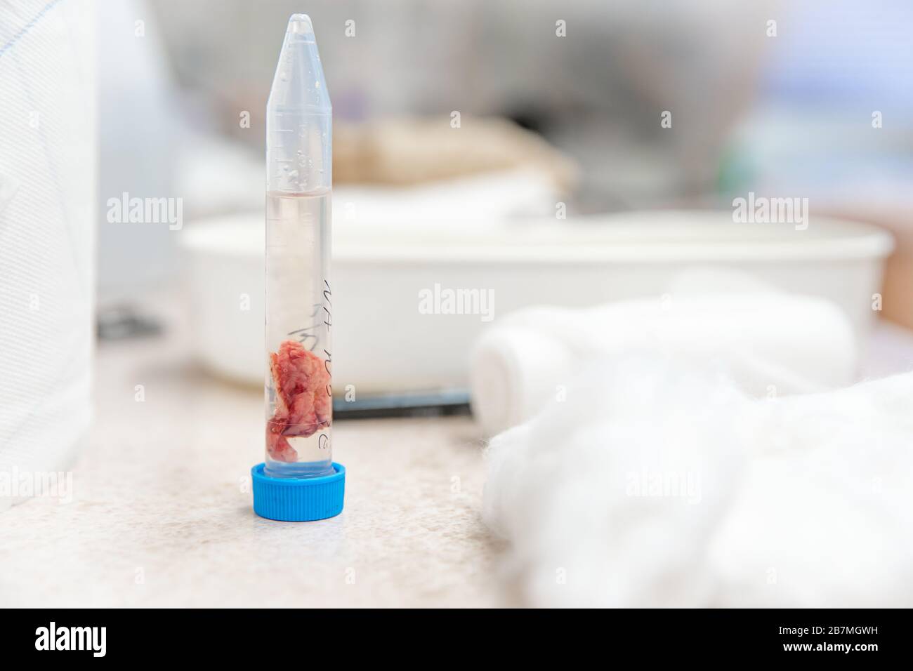 a tissue sample from the tumor to be sent for histological expertise Stock Photo