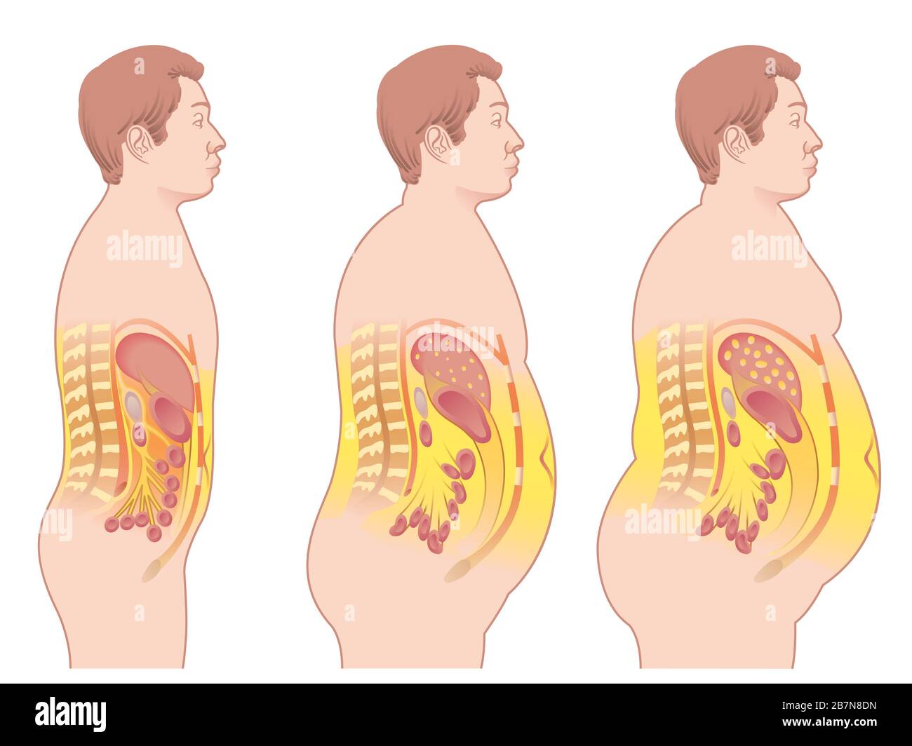 Medical illustration of the consequences of obesity. Stock Photo