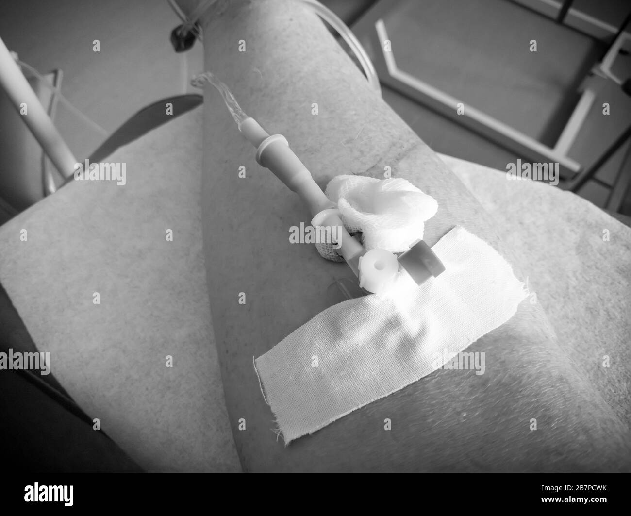 Intravenous catheter in the patient's hand. The introduction of drugs for various diseases. Black and white image. Photo with vignetting Stock Photo