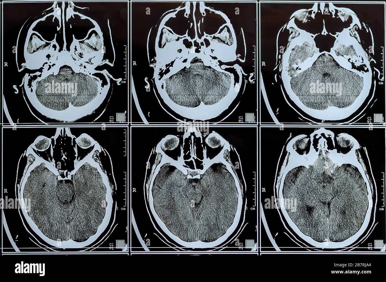 MRI scan of the brain. MRI brain scan or xray neurology human head