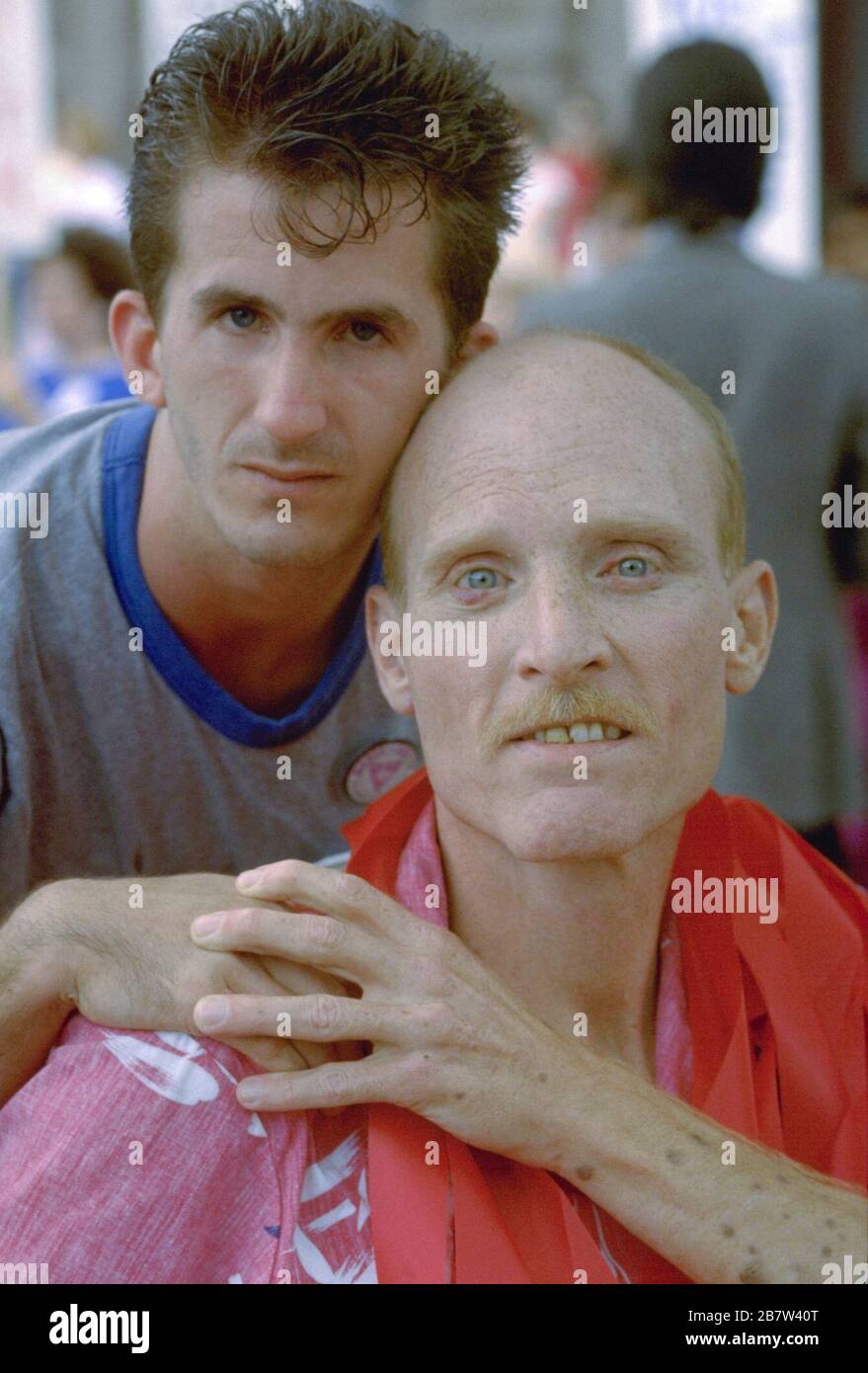 Austin, Texas: Effects of AIDS: Aids victim Sores on the arms of an ...