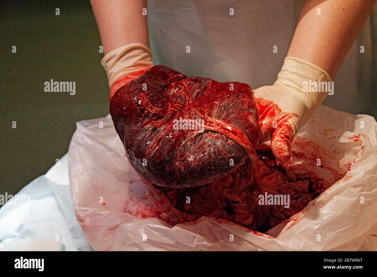 a nurse shows what a placenta looks like, sometimes called the tree of life Stock Photo