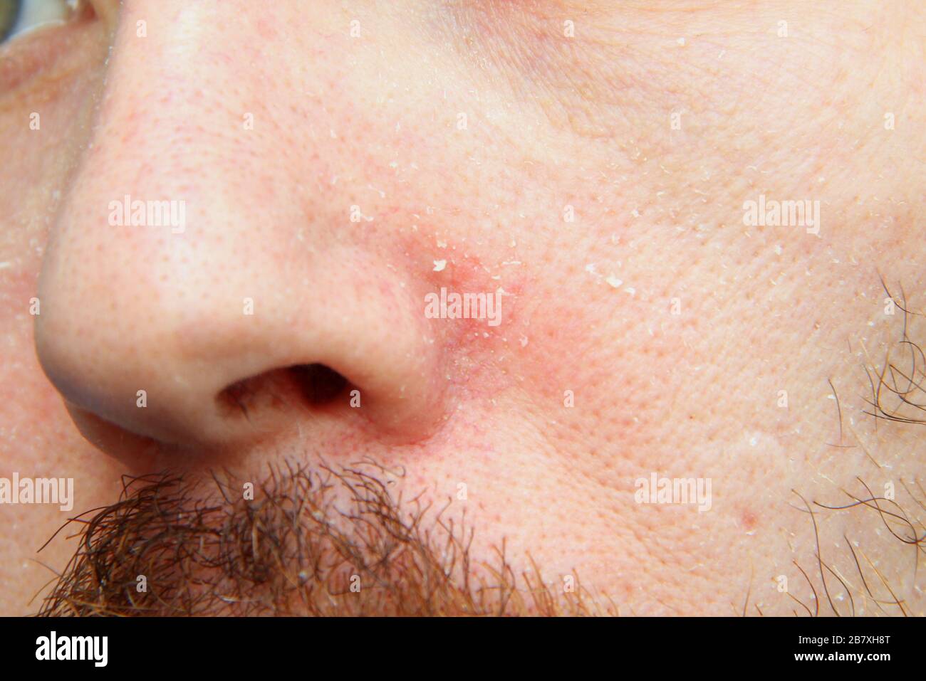 Part of the face with the nose of an adult white man with dry, flaky skin. Skin problems and diseases. Stock Photo
