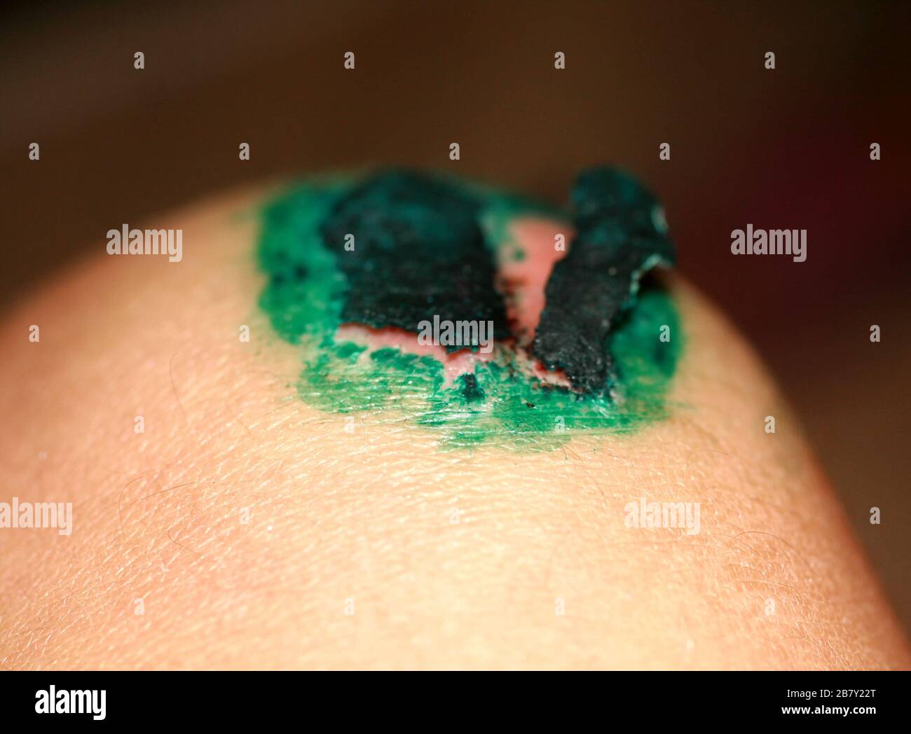 Healing wound on the knee. The wound treated with brilliant green. The scab will climb Stock