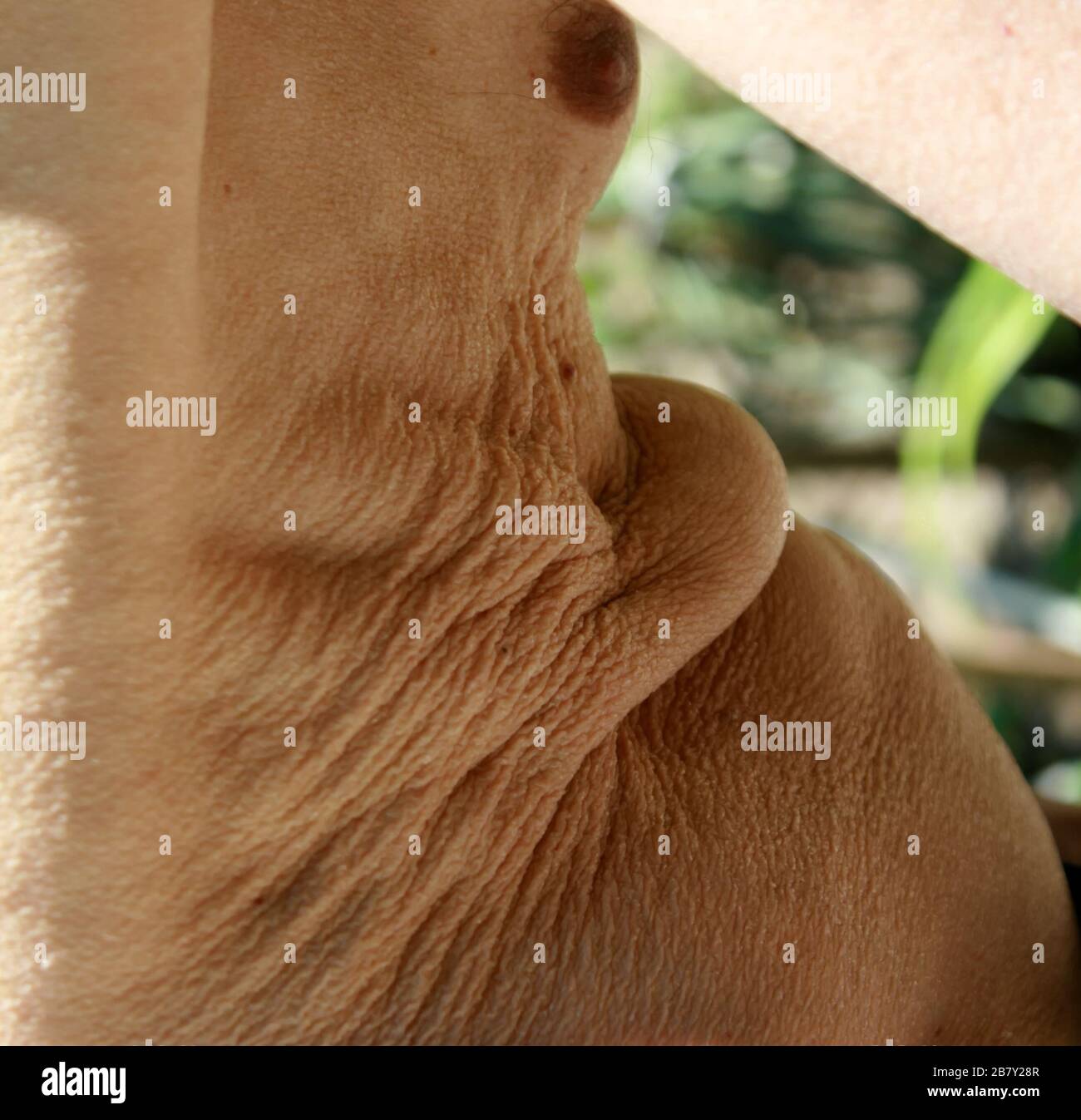 Flabby skin. Skin fold on the abdomen and chest Stock Photo