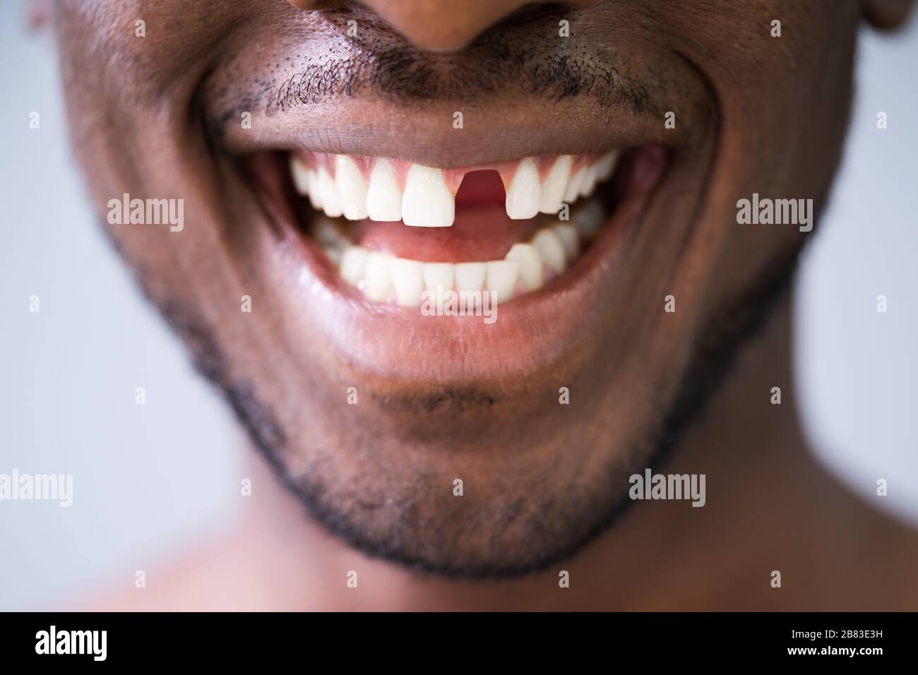 Close Up Photo Of Young Man With Missing Tooth Stock Photo