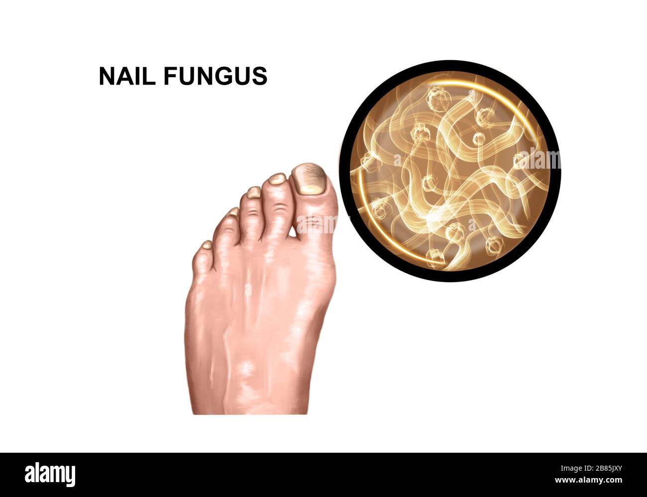 Illustration of the fungal lesion of the foot Stock Photo
