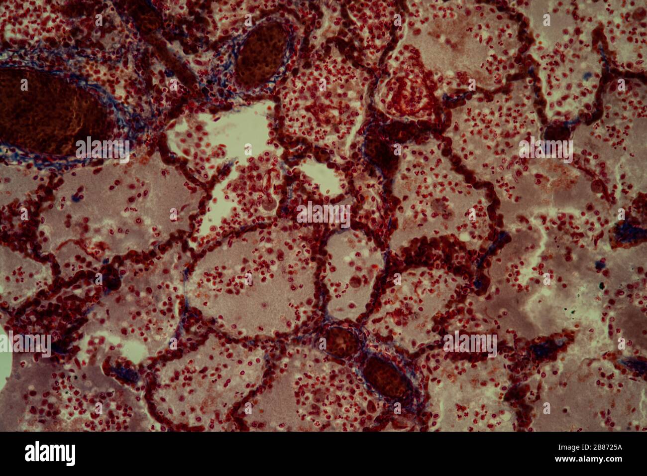 Pulmonary tuberculosis tissue under the microscope 200x Stock Photo