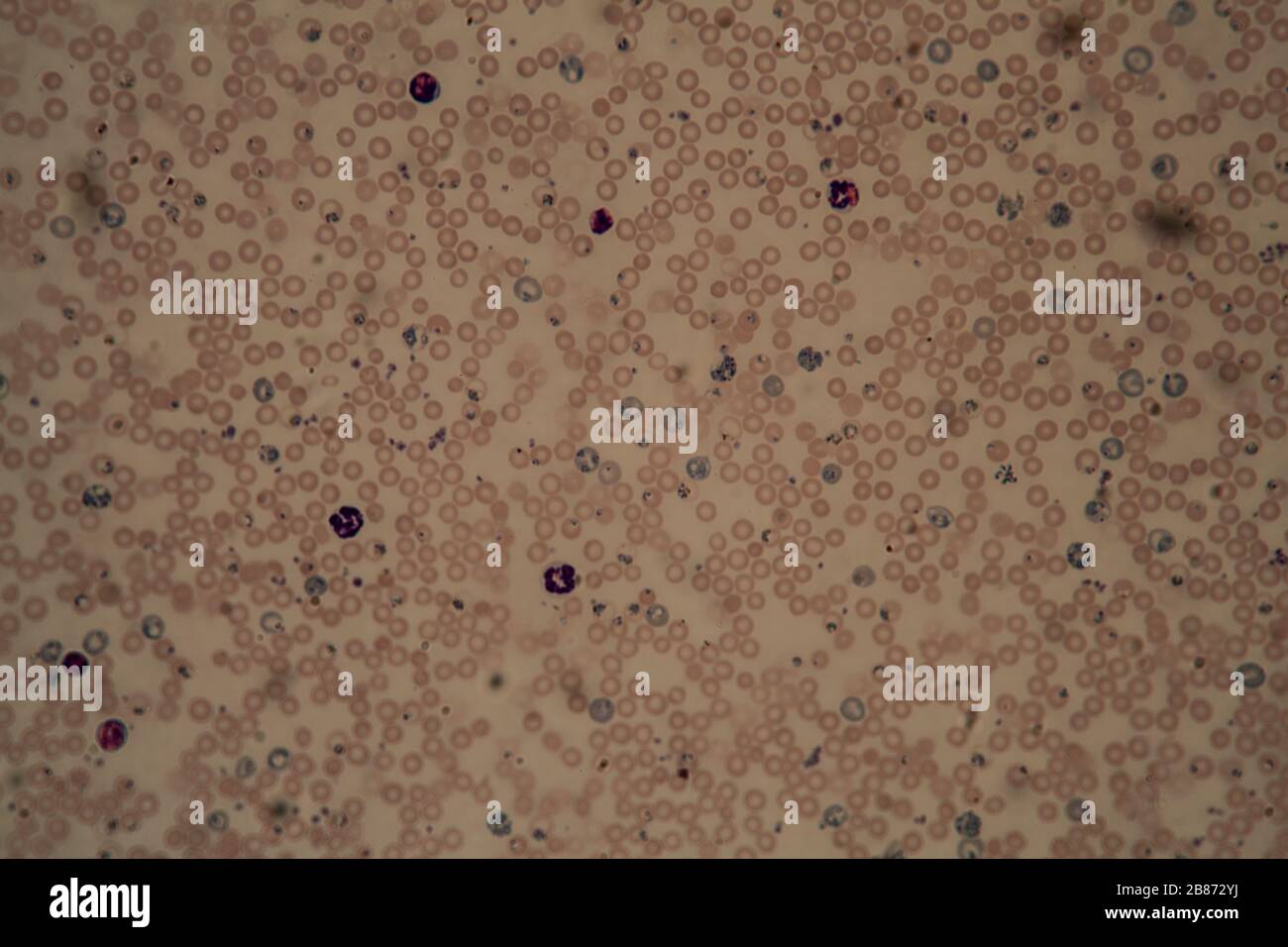 Malaria Parasites In Red Blood Cells Under The Microscope 400x Stock Photo Alamy