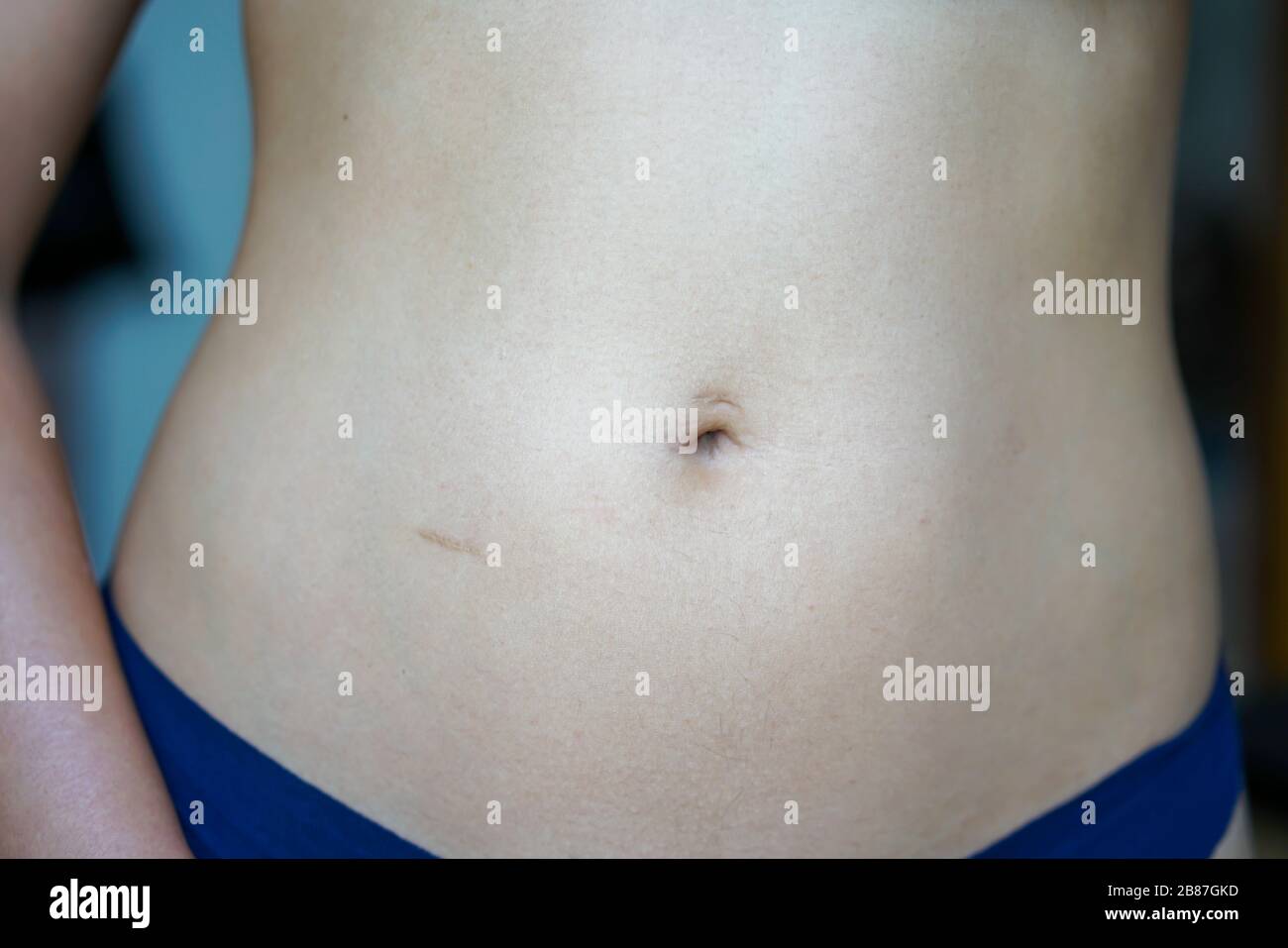 Woman belly with small healed scars after an inguinal hernia operation. Stock Photo