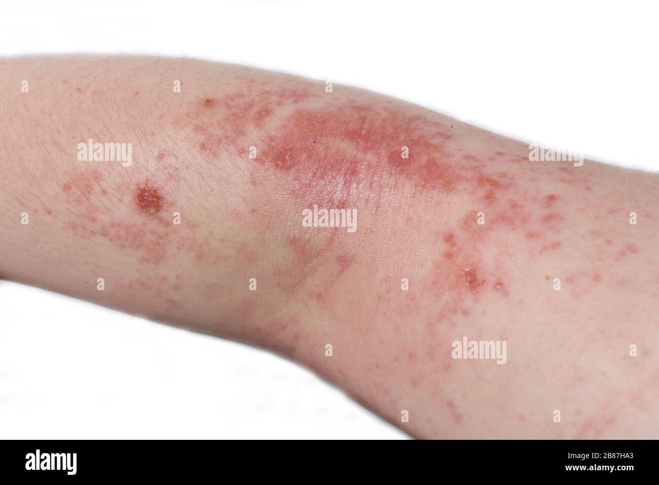 Red, itchy eczema rash on the elbow of a teenage boy Stock Photo - Alamy