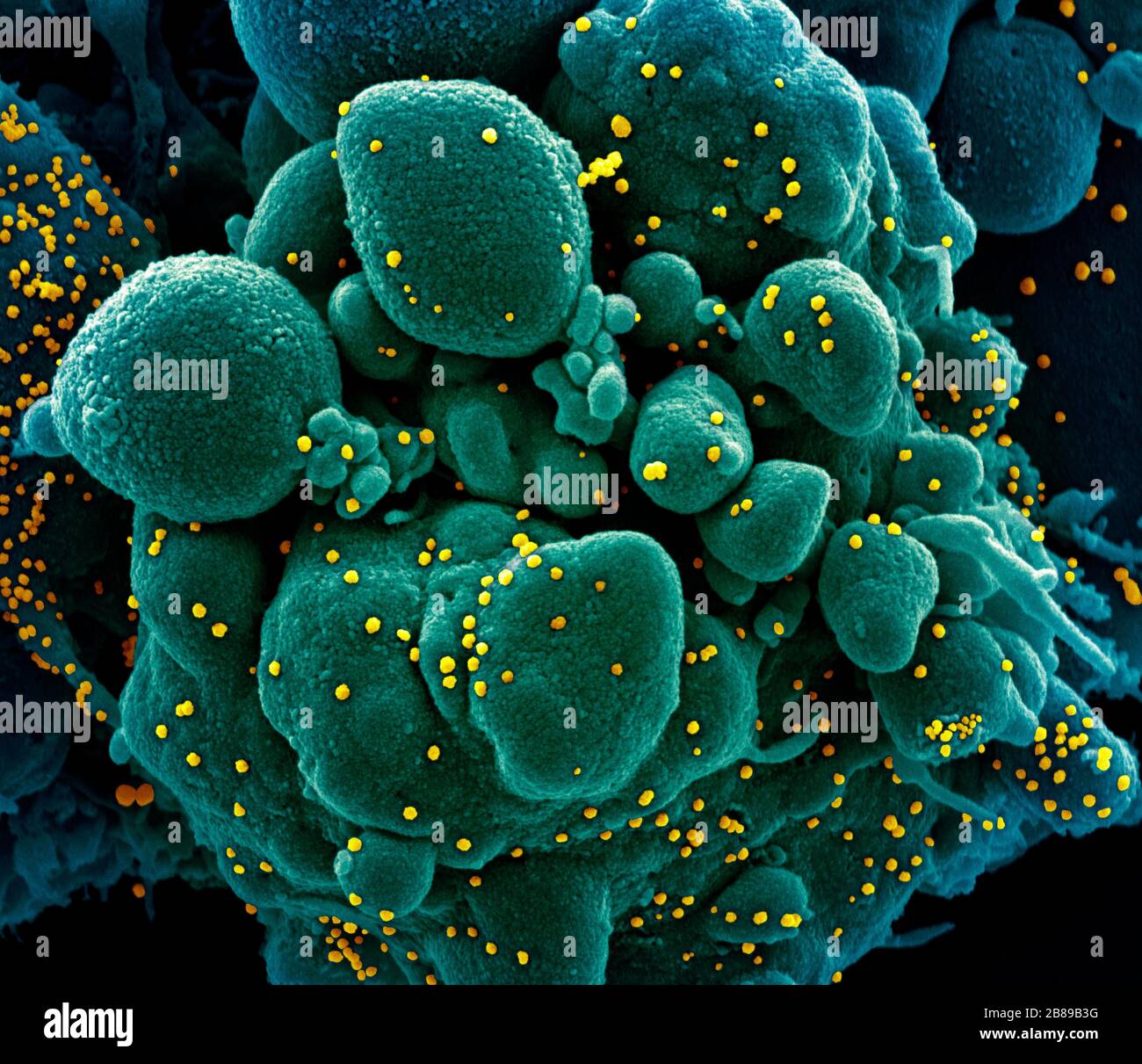 A transmission electron micrograph of COVID-19, novel coronavirus, an apoptotic cell heavily infected with SARS-COV-2 virus particles, isolated from a patient sample at the NIAID Integrated Research Facility March 19, 2020 in Fort Detrick, Maryland. Stock Photo