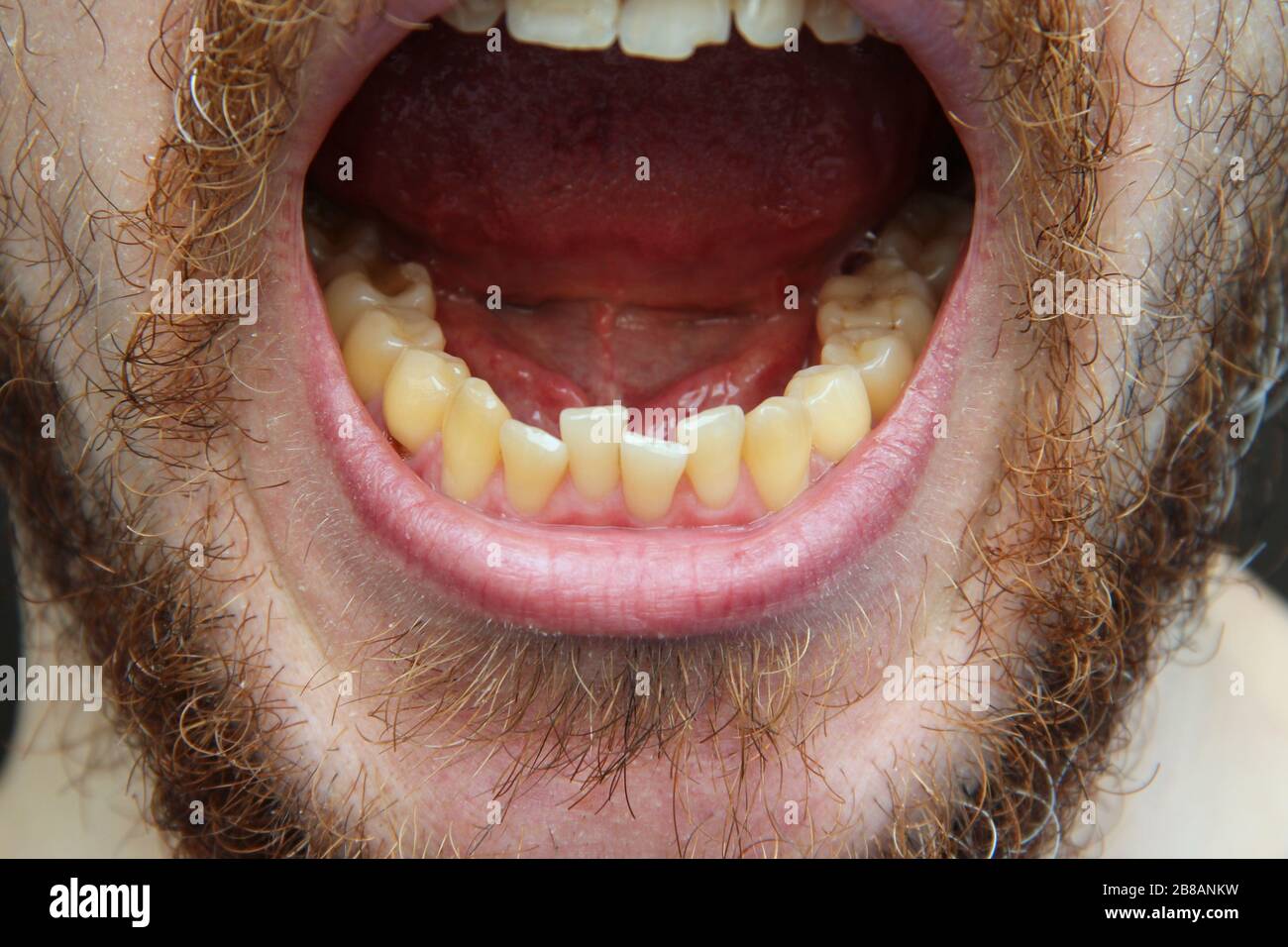 A white man with a beard and mustache shows his teeth and open mouth. Close-up part of the face, yellowish teeth, cheeks and chin. Medicine, oral health. Stock Photo