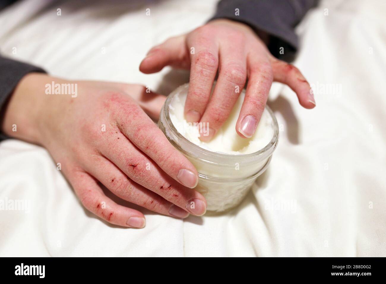 A young child is applying moisturizing lotion to his extremely cracked and dry skin on his hands