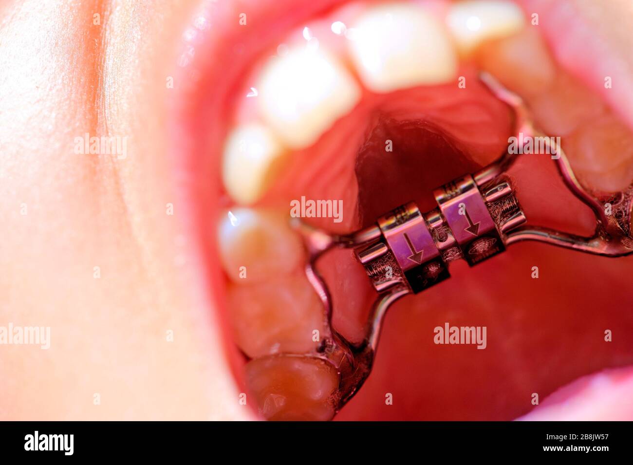Closeup inside mouth with orthodontics equipment Stock Photo Alamy