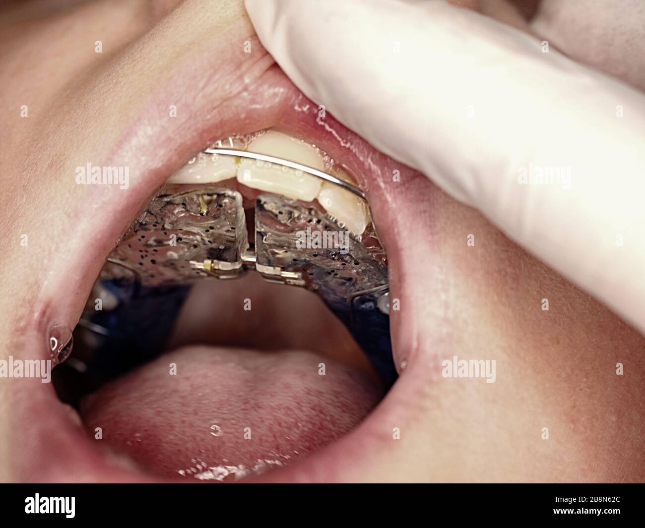 Orthodontist inserting ligatures into children mouth, orthodontic