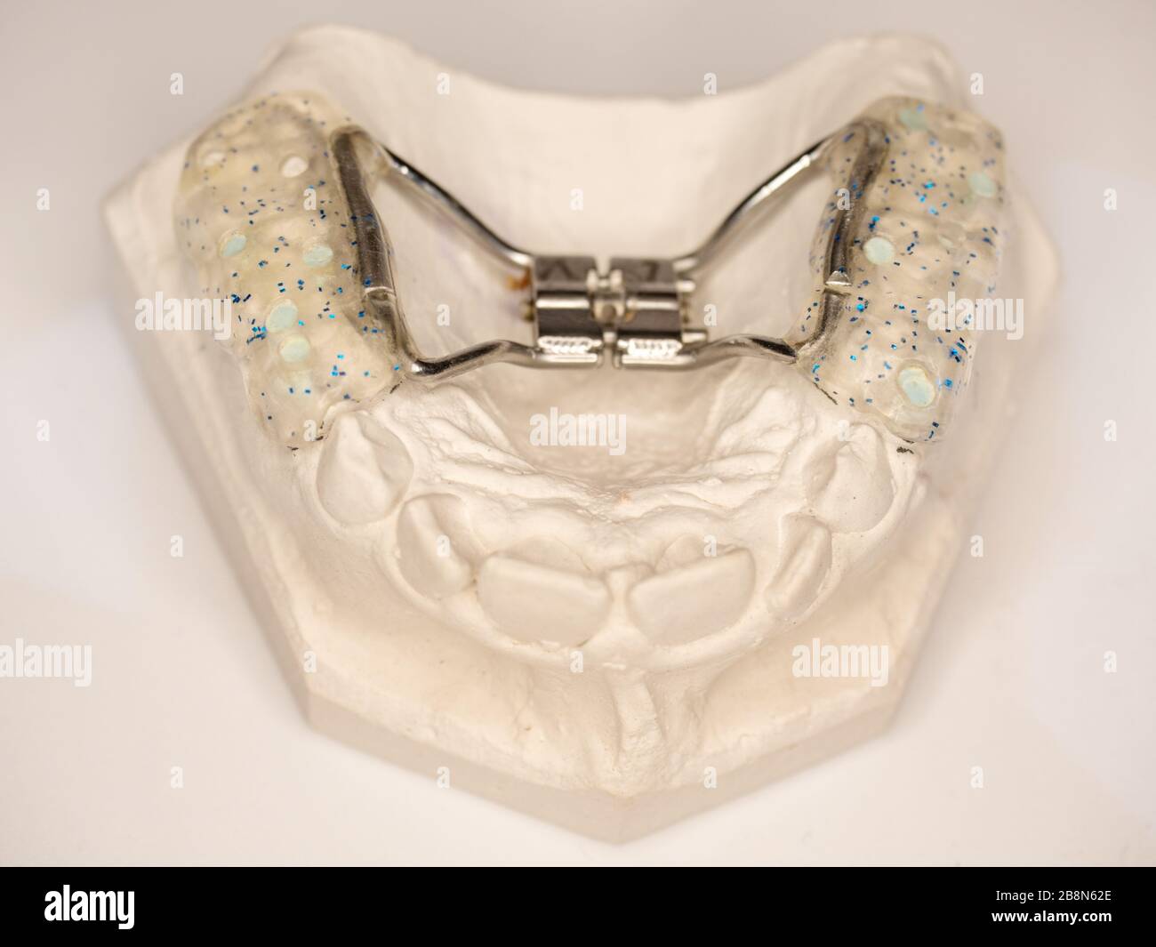 Check hyrax braces on dental gypsum model. Banded Hyrax Expander rapid