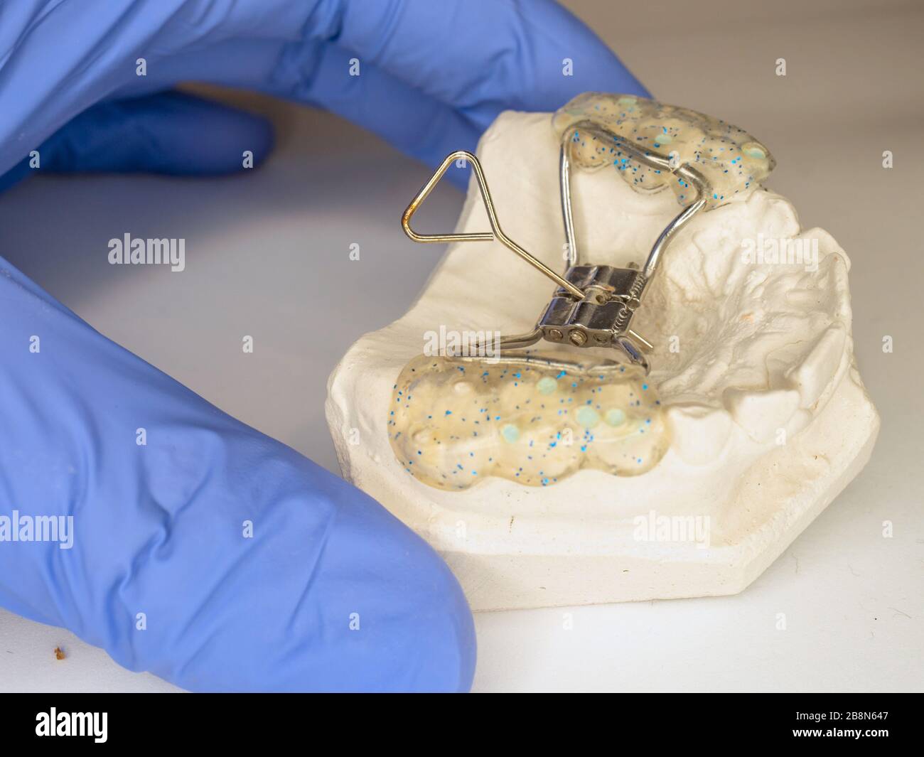 Dentist check in fingers patient teeth model with Hyrax Expander braces