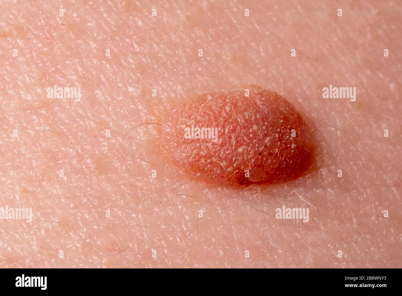 Large mole close-up. Macro shot of benign skin lesion on caucasian, human skin. Proliferation of pigment derma cells, melanocytic pigmented nevus Stock Photo