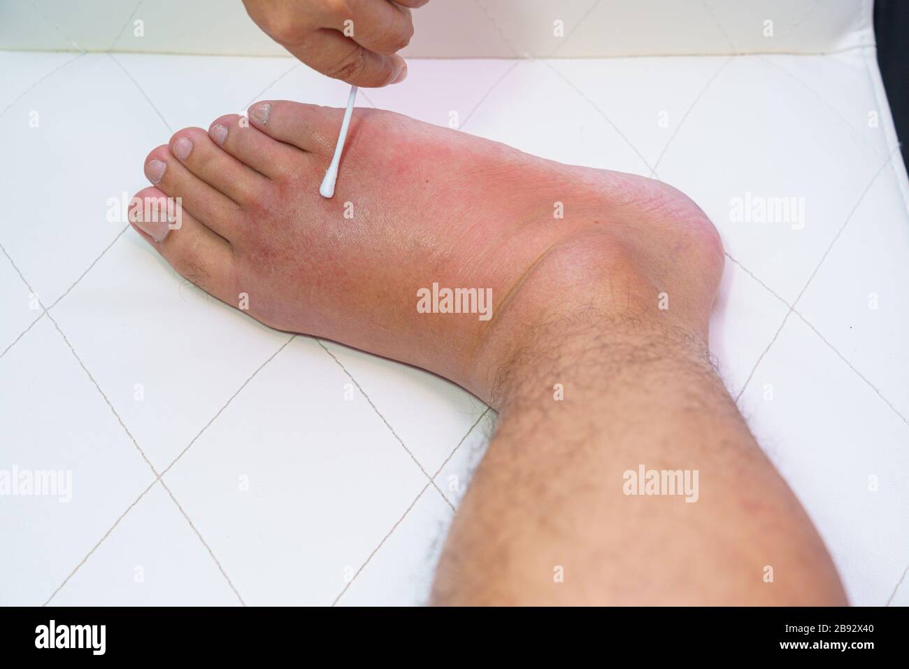 Close up old man right foot, Ankle wounded waiting and swelling infectious  disease by bee sting allergic reactions nurse treatment on wound dressing a  Stock Photo - Alamy