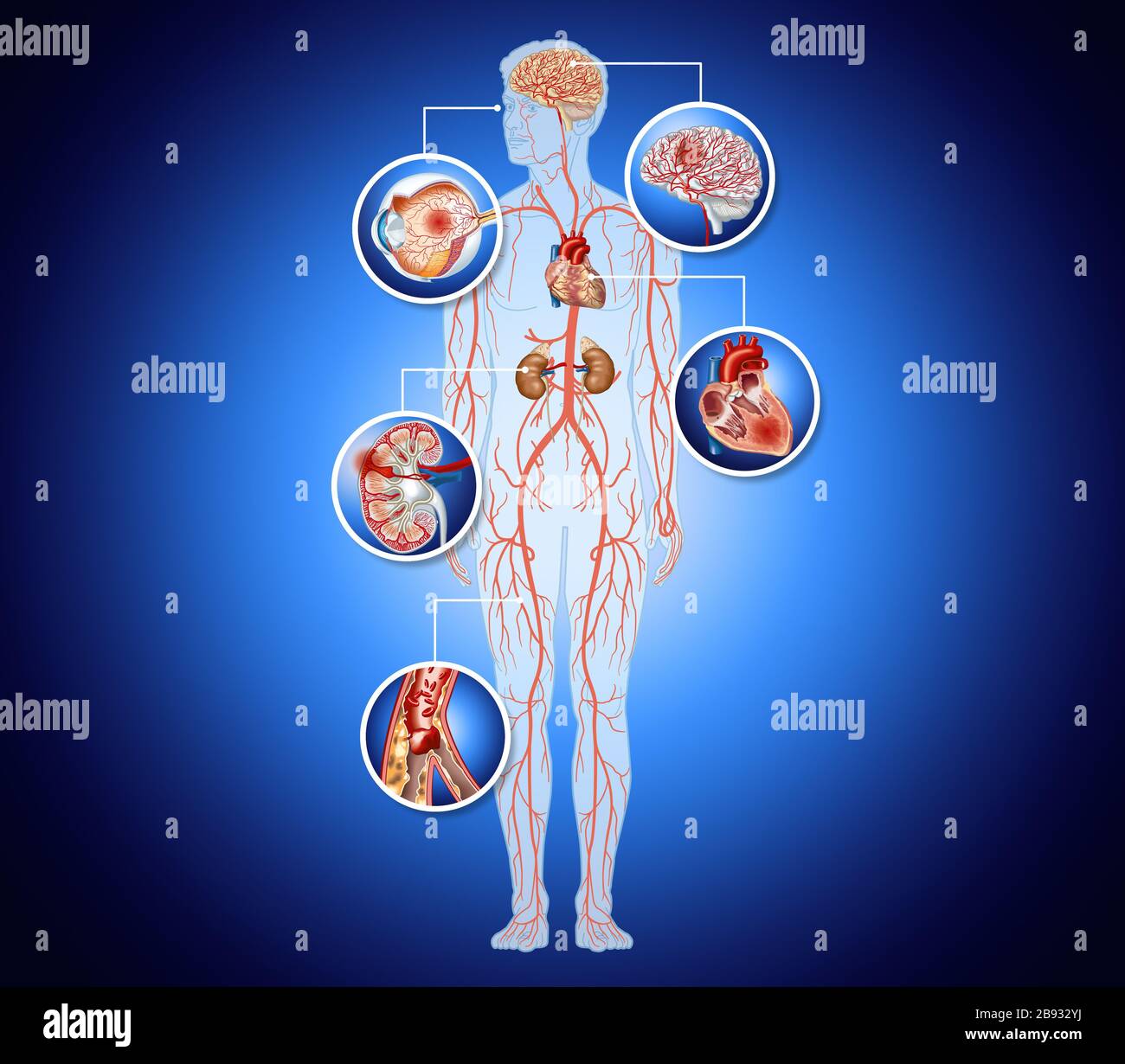 Arteriosclerosis Hi res Stock Photography And Images Alamy