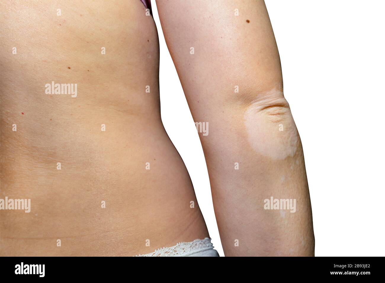 Young Woman in White Underwear Applies Ointment for the Rash To the Elbows.  Treatment of Dermatological Diseases Stock Image - Image of body,  dermatological: 241384777