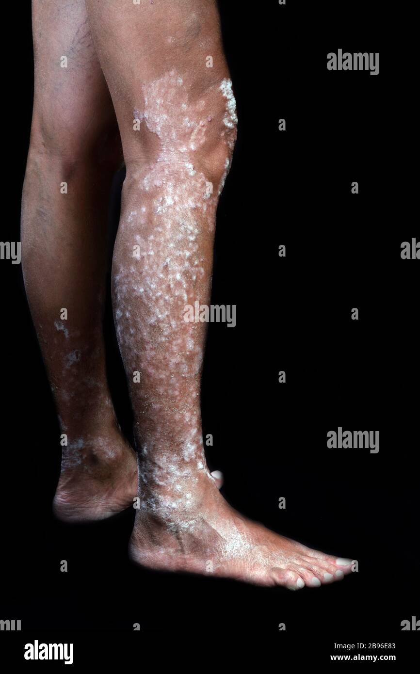 Skin Diseases Psoriasis On The Legs Stock Photo Alamy